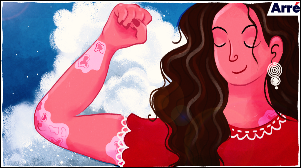 “What’s That On Your Hand?”: What’s It Like to Live with a Permanent Skin Disorder